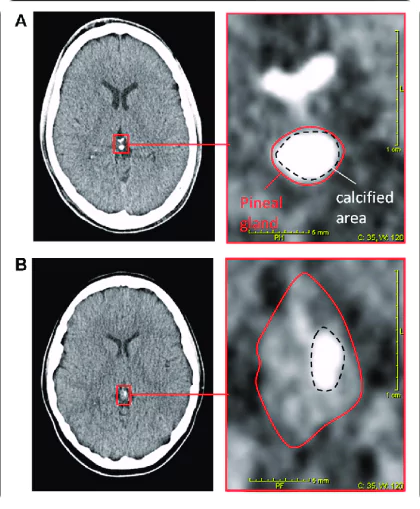 significant calcification